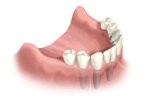 Replacing one or more teeth by implantology. Dentist and implantologist The Hague